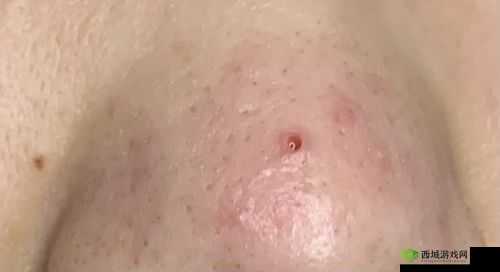 粗大黑头紫大黑头紫挤进：一个奇特现象