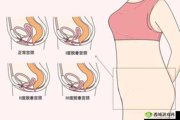 女性得阴挺病是怎么回事：病因与治疗